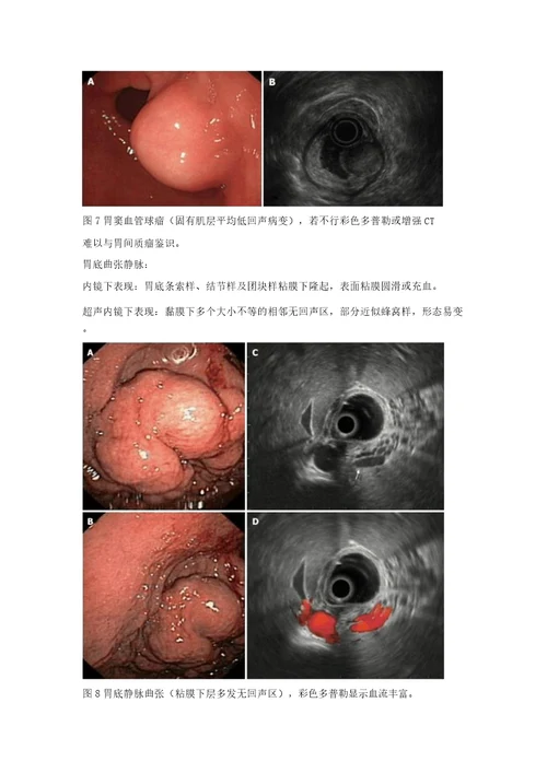 消化道黏膜下肿物白光内镜及超声内镜下特点教案