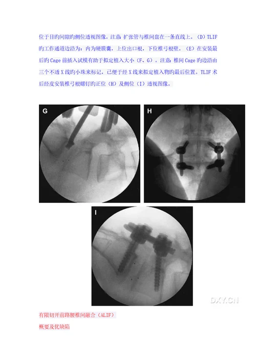 微创脊柱外科腰椎椎间融合的微创技术