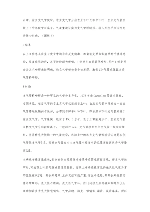 以反复喘息为表现的支气管桥畸形3例病例分析.docx