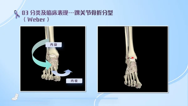 蓝紫色医疗风踝关节骨折护理查房护理PPT模板pptx