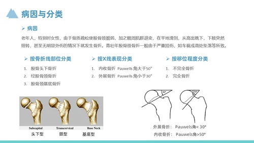 蓝色简约风股骨颈骨折护理查房培训课件