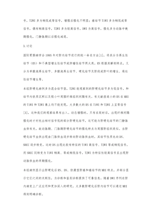核磁共振对肝硬化肝内结节的诊断价值柳广东.docx