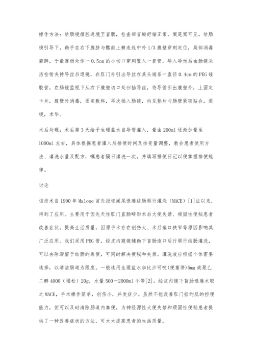 经皮内窥镜辅助下盲肠造口结肠顺行灌肠术3例报告.docx