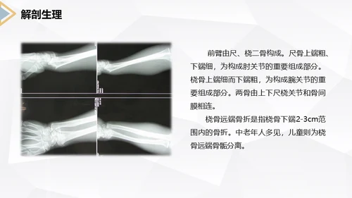 左桡尺骨双骨折护理查房通用PPT模板