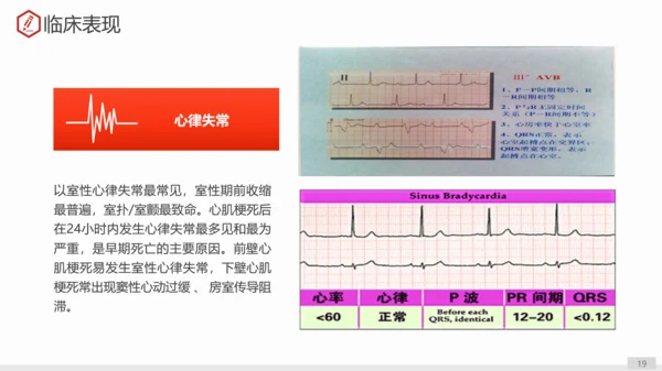 急性心肌梗死术后护理查房PPT教学课件