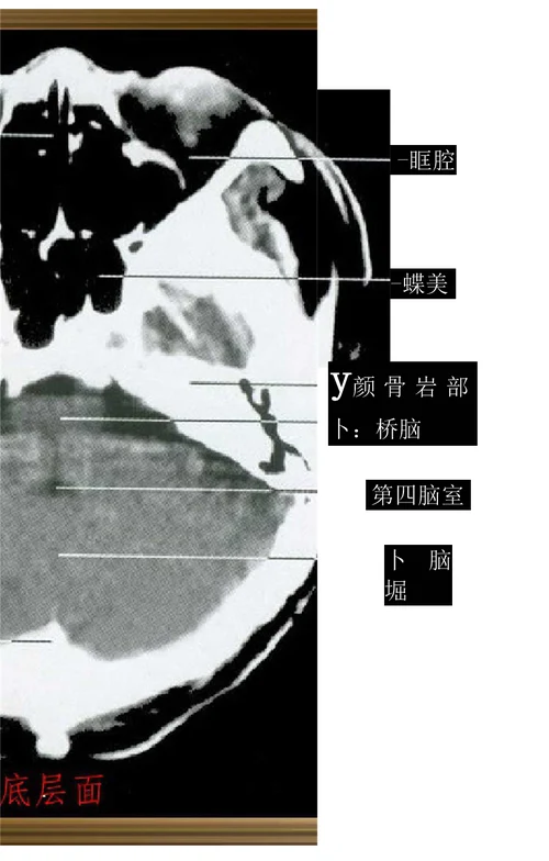 中枢神经系统断层影像