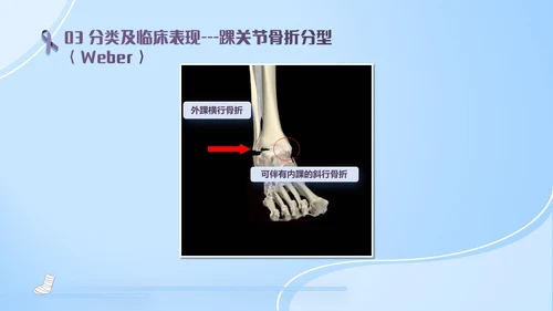 蓝紫色医疗风踝关节骨折护理查房护理PPT模板pptx