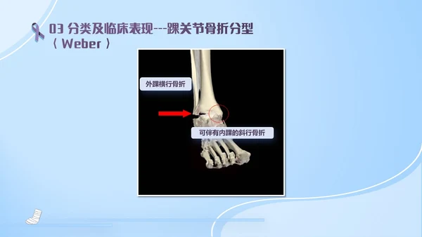 蓝紫色医疗风踝关节骨折护理查房护理PPT模板pptx