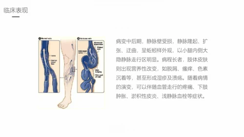下肢静脉曲张护理专业教学PPT课件