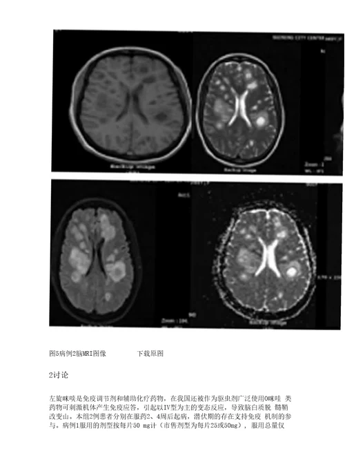 2例左旋咪呼诱发多灶性白质脑病的临床分析