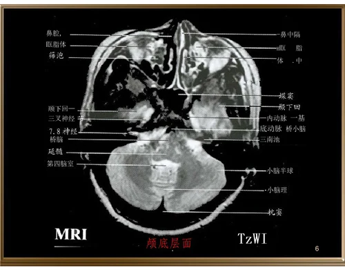 中枢神经系统断层影像