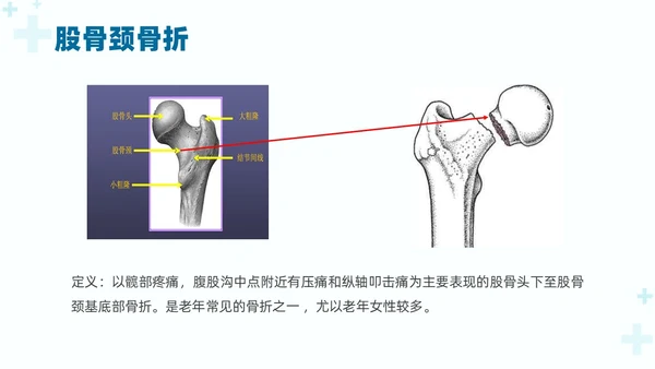 绿色实拍医疗护理培训股骨骨折护理查房培训PPT课件