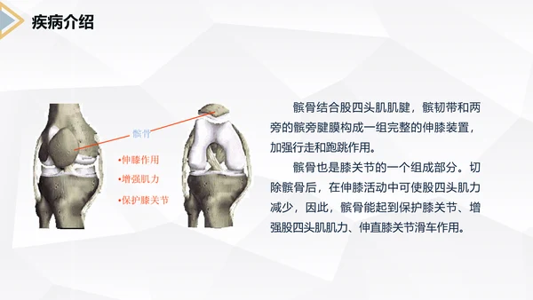 髌骨骨折术后护理知识教学PPT课件