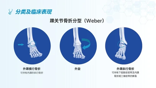 蓝色简约形状踝骨骨折护理查房医护培训ppt