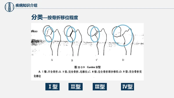 股骨颈骨折术后护理查房培训教学PPT课件