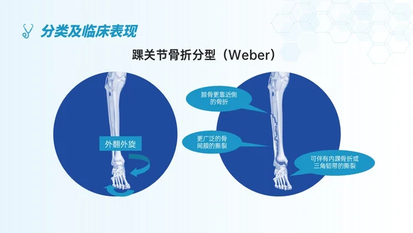 蓝色简约形状踝骨骨折护理查房医护培训ppt