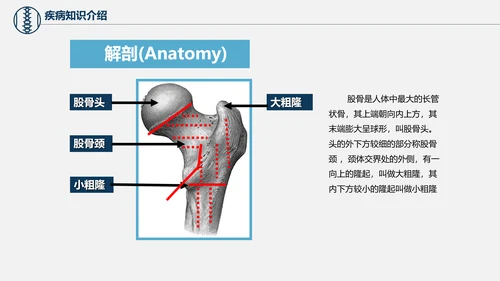 股骨颈骨折术后护理查房培训教学PPT课件