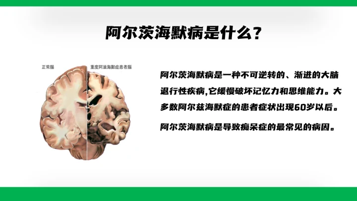 脑病科大脑疾病阿尔茨海默病通用PPT模板