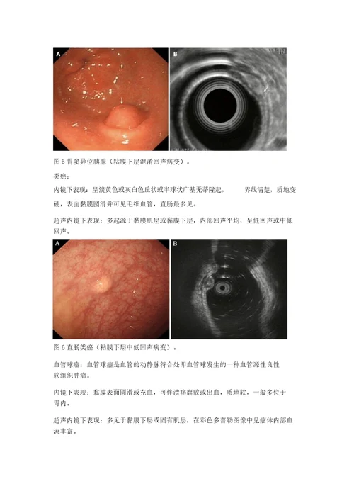 消化道黏膜下肿物白光内镜及超声内镜下特点教案