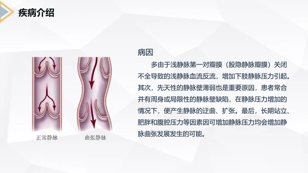 下肢静脉曲张护理查房医疗教学PPT课件