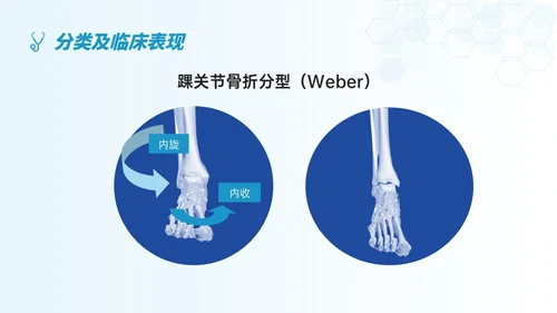 蓝色简约形状踝骨骨折护理查房医护培训ppt
