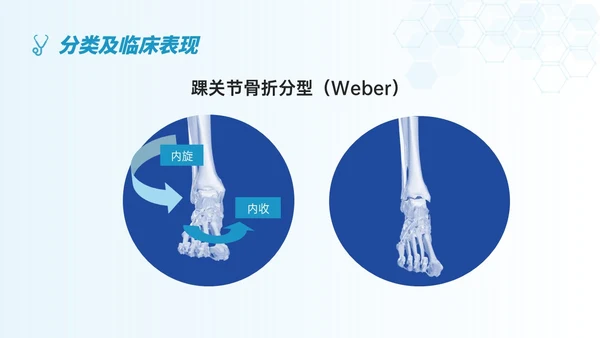 蓝色简约形状踝骨骨折护理查房医护培训ppt