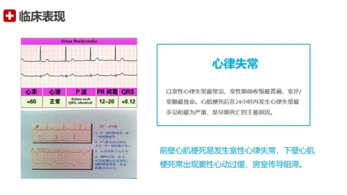 急性心梗术后护理查房通用PPT模板