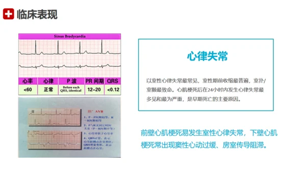 急性心梗术后护理查房通用PPT模板