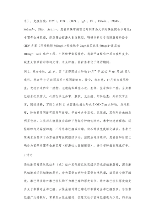宫颈恶性淋巴肿瘤2例报道.docx
