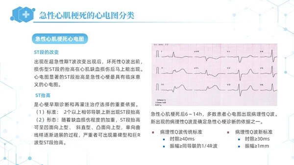 蓝色简约急性心肌梗死培训课件PPT模板