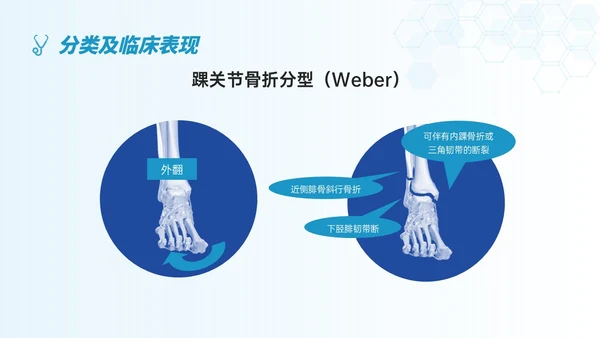 蓝色简约形状踝骨骨折护理查房医护培训ppt