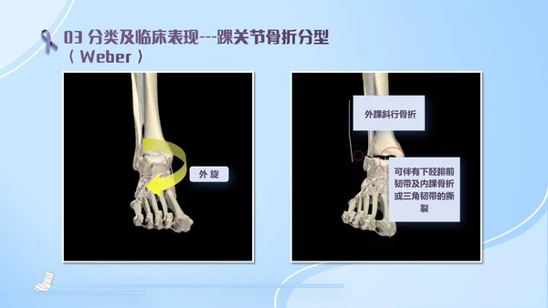 蓝紫色医疗风踝关节骨折护理查房护理PPT模板pptx
