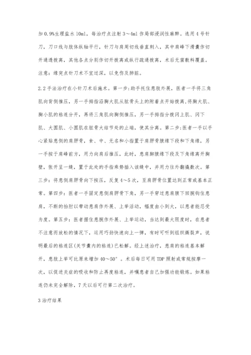 小针刀配合手法治疗肩关节周围炎.docx