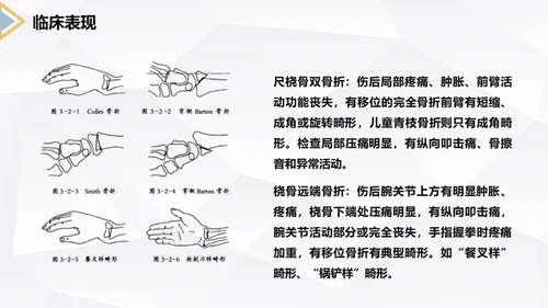 左桡尺骨双骨折护理查房通用PPT模板