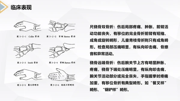 左桡尺骨双骨折护理查房通用PPT模板