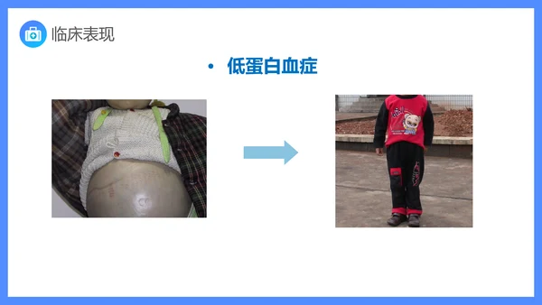 原发性肾病综合症医疗护理查房PPT课件模板