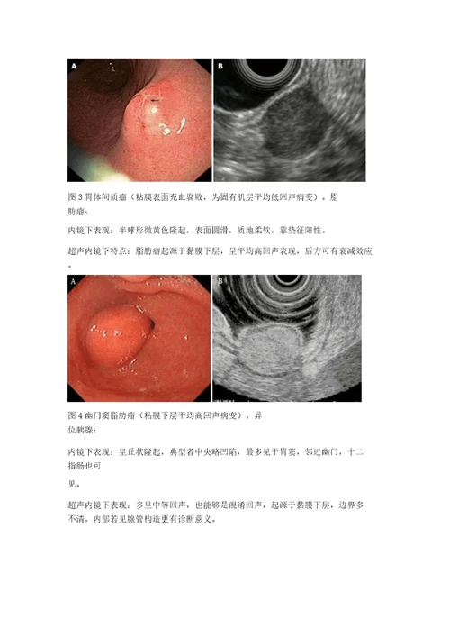消化道黏膜下肿物白光内镜及超声内镜下特点教案