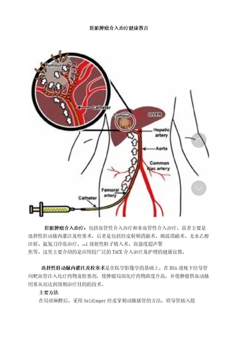 介入治疗肝脏肿瘤健康教育