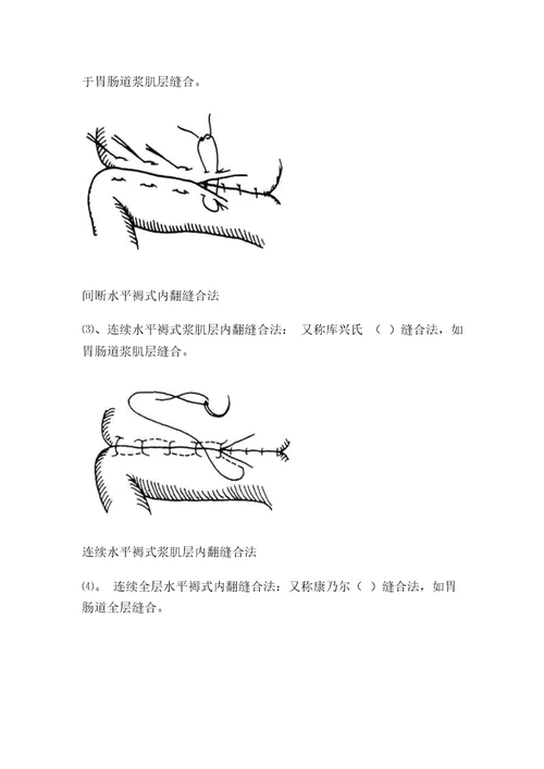 外科手术缝合法