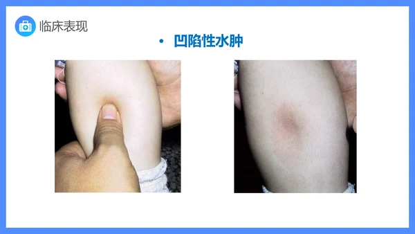 原发性肾病综合症医疗护理查房PPT课件模板