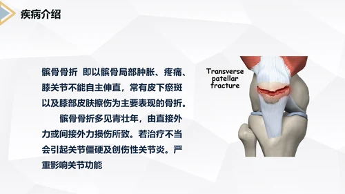 髌骨骨折术后护理知识教学PPT课件