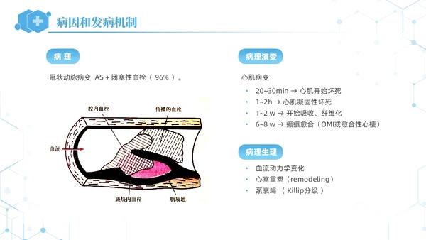 蓝色简约急性心肌梗死培训课件PPT模板