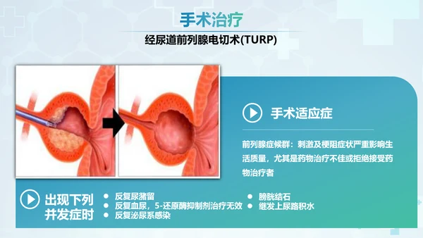 前列腺增生术后康复护理PPT模板