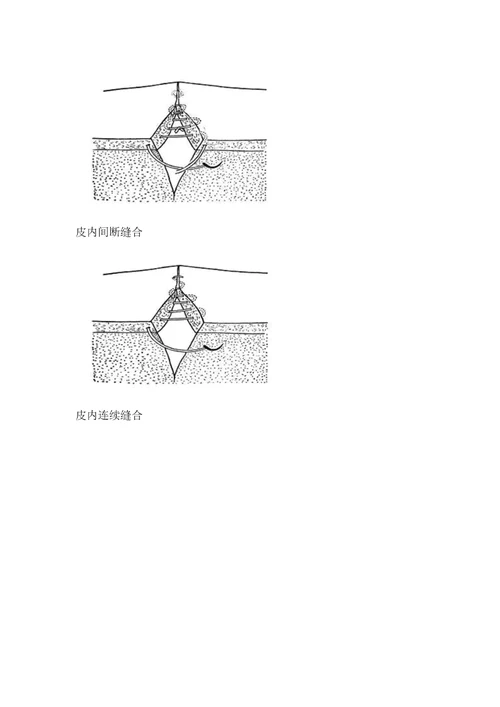 外科手术缝合法