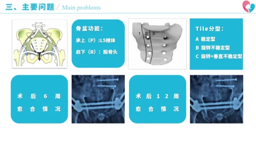 骨盆骨折术后康复历程通用PPT模板