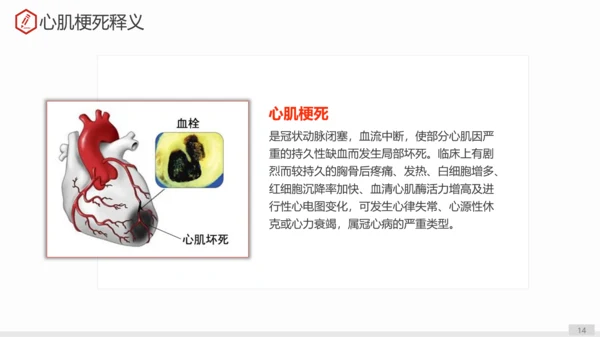 急性心肌梗死术后护理查房PPT教学课件