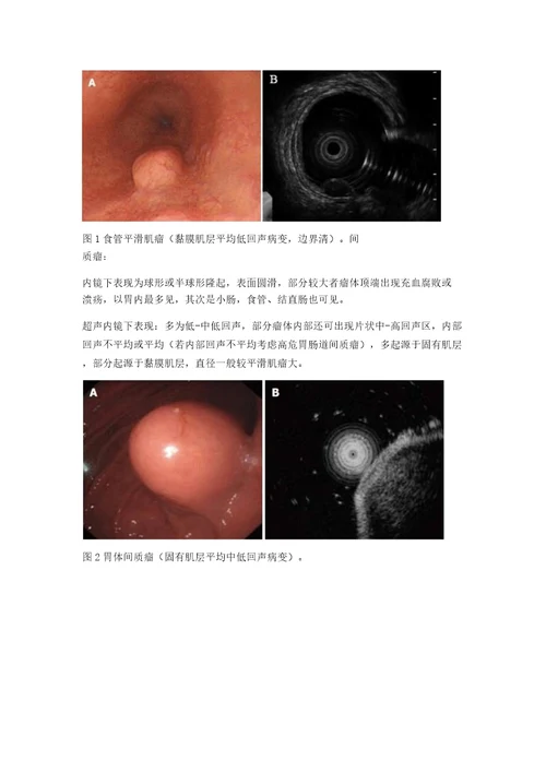 消化道黏膜下肿物白光内镜及超声内镜下特点教案