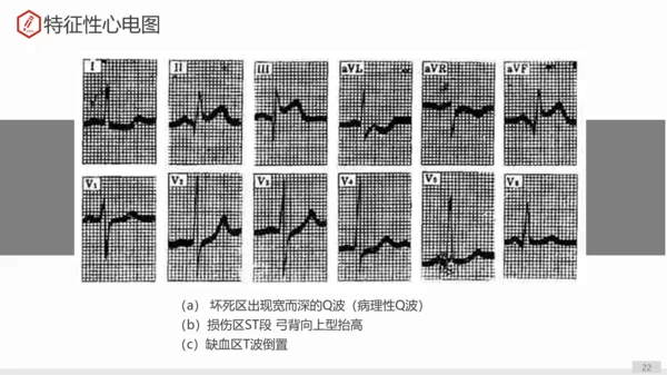 急性心肌梗死术后护理查房PPT教学课件