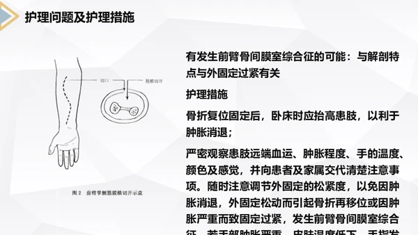 左桡尺骨双骨折护理查房通用PPT模板