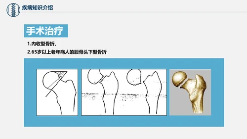 股骨颈骨折术后护理查房培训教学PPT课件